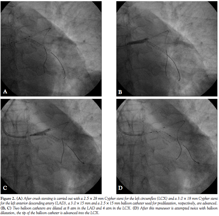 BuddyBalloon Technique for Final KissingBalloon Dilatation After Crush Stenting of the Left